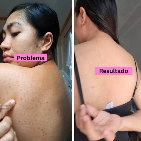 Elimina el acné de tu espalda con un tratamiento fácil y efectivo